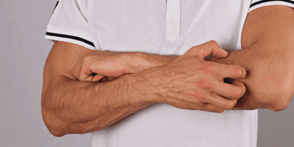 Wat te doen bij een allergische reactie op de huid? Wat te doen bij een allergische reactie op de huid?