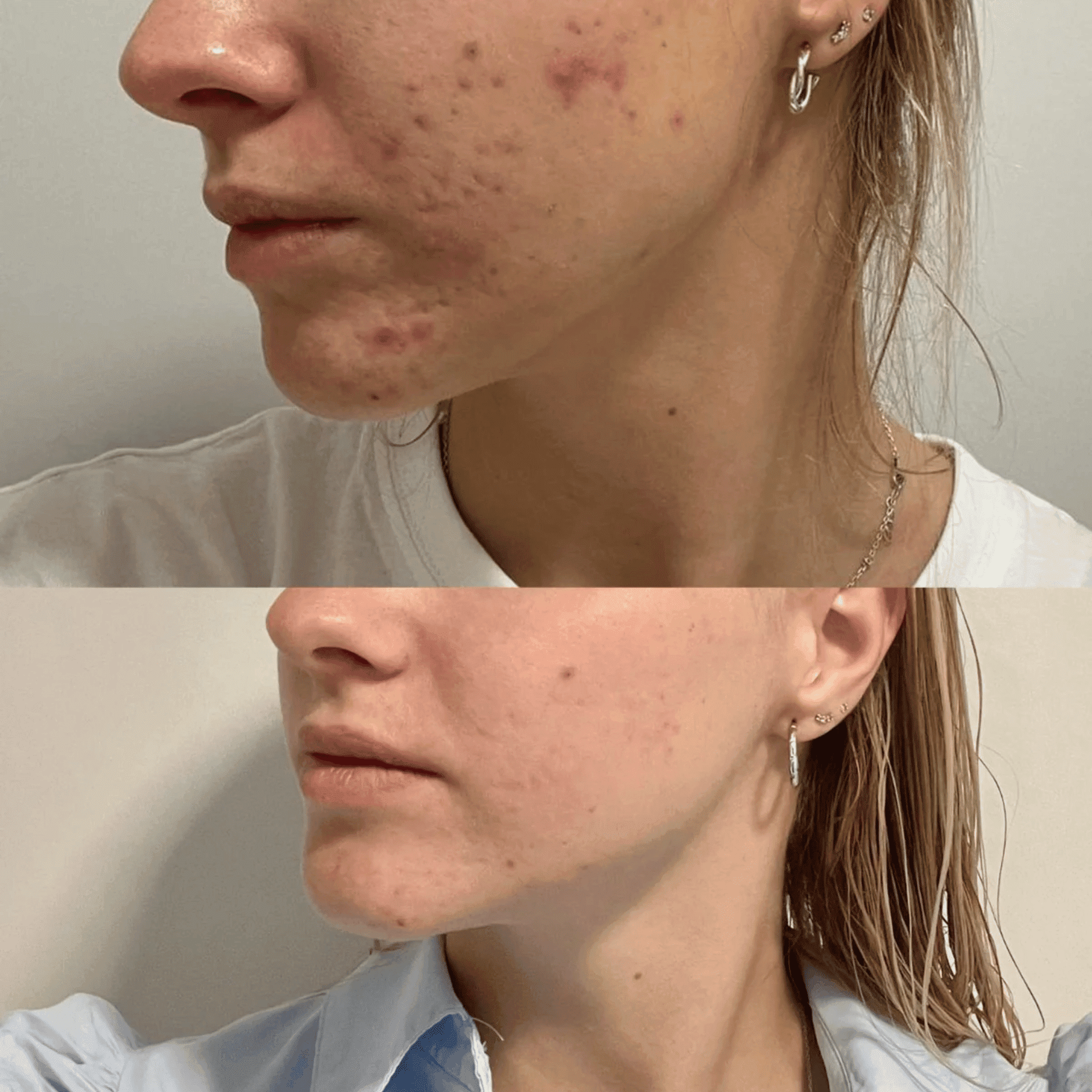 Ray Acne Prone Skin Wash Gel Ray Acne Prone Skin Wash Gel