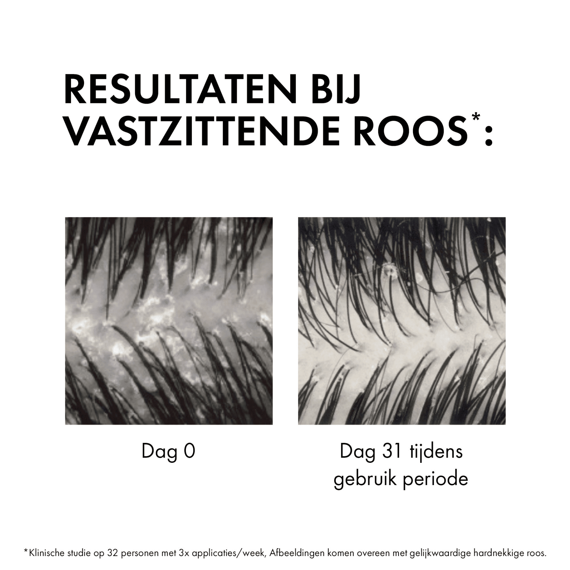 Vichy Dercos Anti-Roos DS Normaal tot Vet Haar