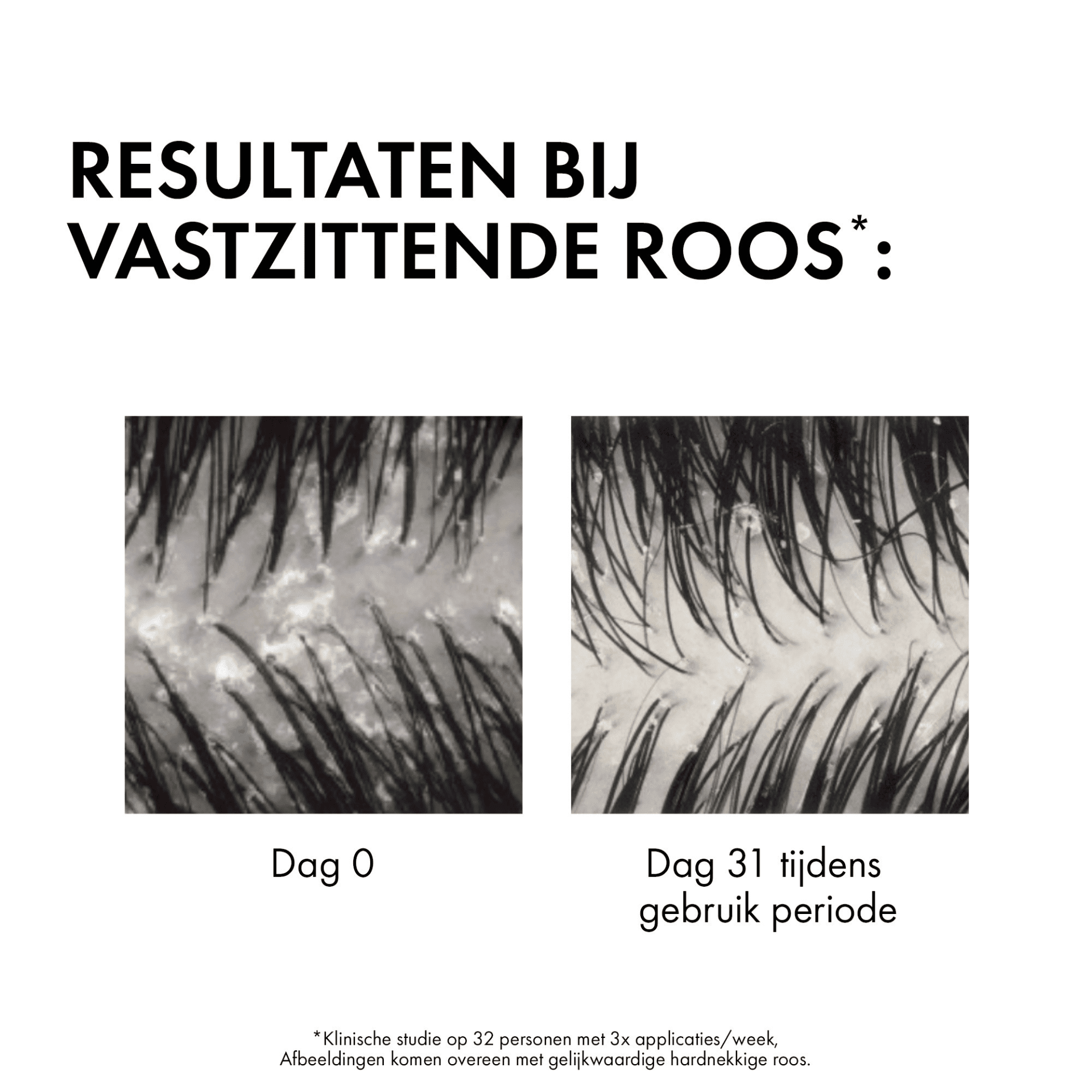 Vichy Dercos Anti-Roos DS Droog Haar