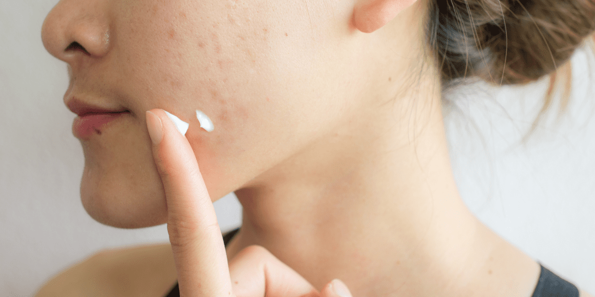 Wat te doen bij een vette huid