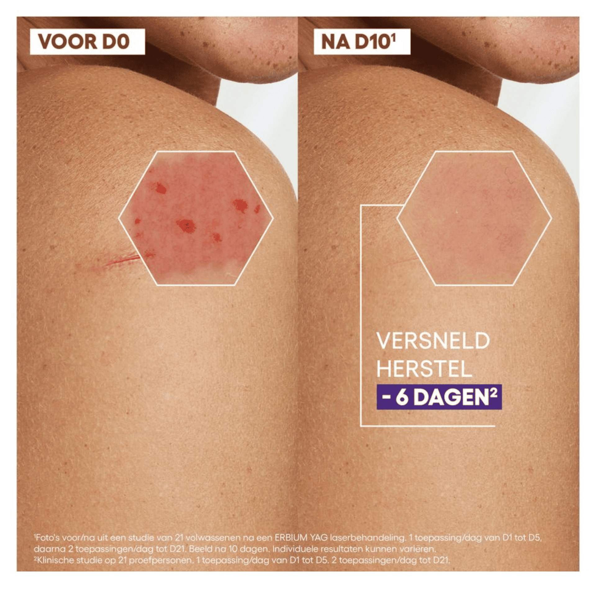 A-Derma Epitheliale Ultra Repair HA+ Herstellende Crème tegen Littekens A-Derma Epitheliale Ultra Repair HA+ Herstellende Crème tegen Littekens