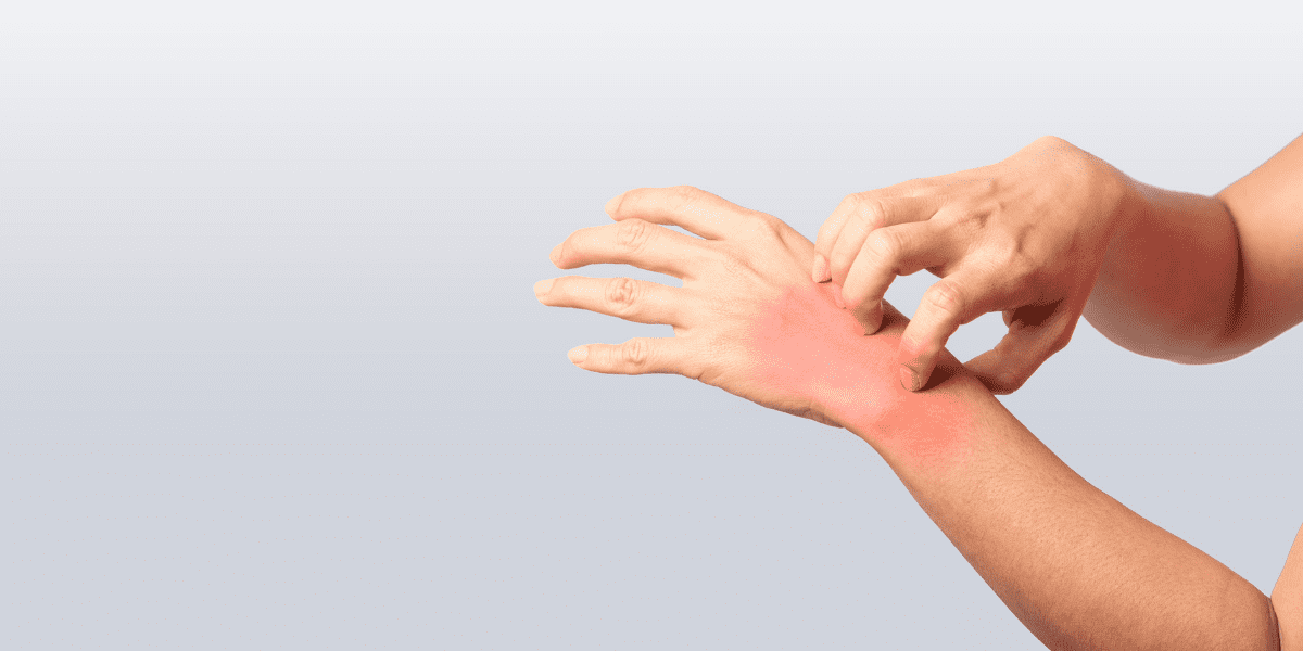 Atopische huid: Oorzaken, symptomen & verzorgingsproducten Atopische huid: Oorzaken, symptomen & verzorgingsproducten