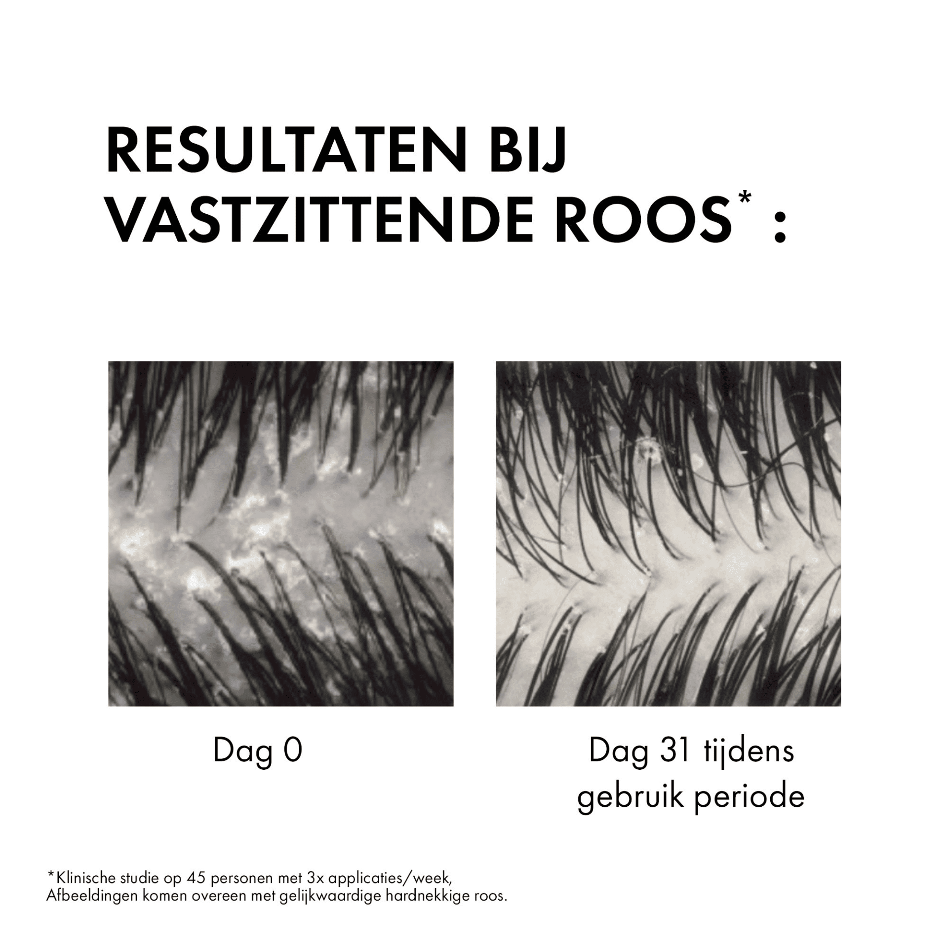 Vichy Dercos Anti-Roos DS Normaal tot Vet Haar Vichy Dercos Anti-Roos DS Normaal tot Vet Haar